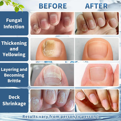Maximum Strength Nail Fungi Treatment, Restore and Repair Damaged, Discolored Nails